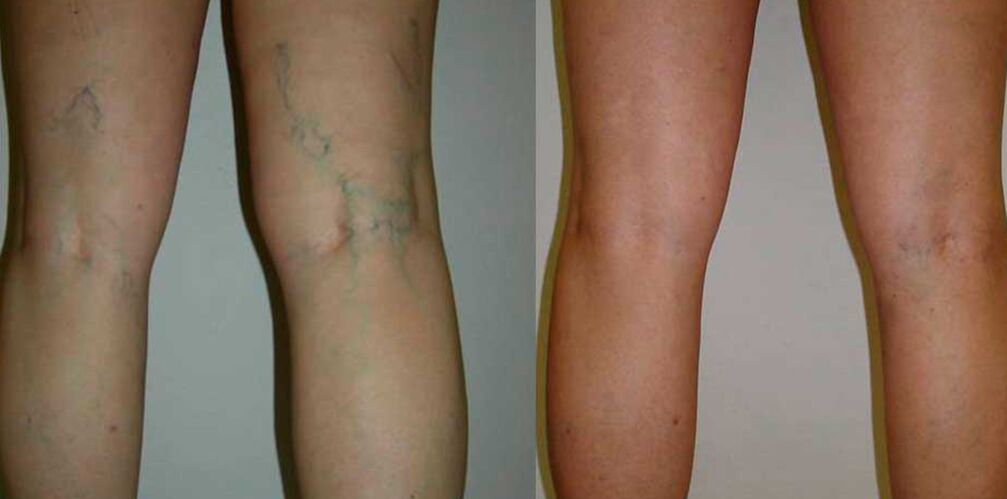 antes e despois do tratamento de varices con Levicose