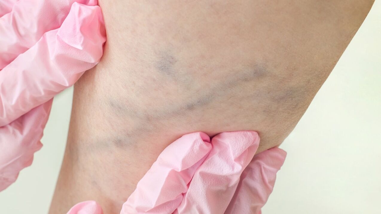 Varices