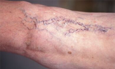 Métodos para tratar varices nas pernas