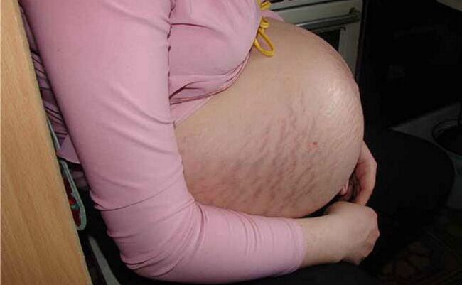 Causas das varices durante o embarazo