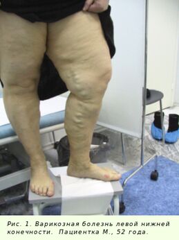 As varices necesitan ser tratadas para deter o proceso