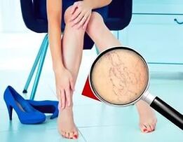 Os síntomas dependen do tipo e fase das varices