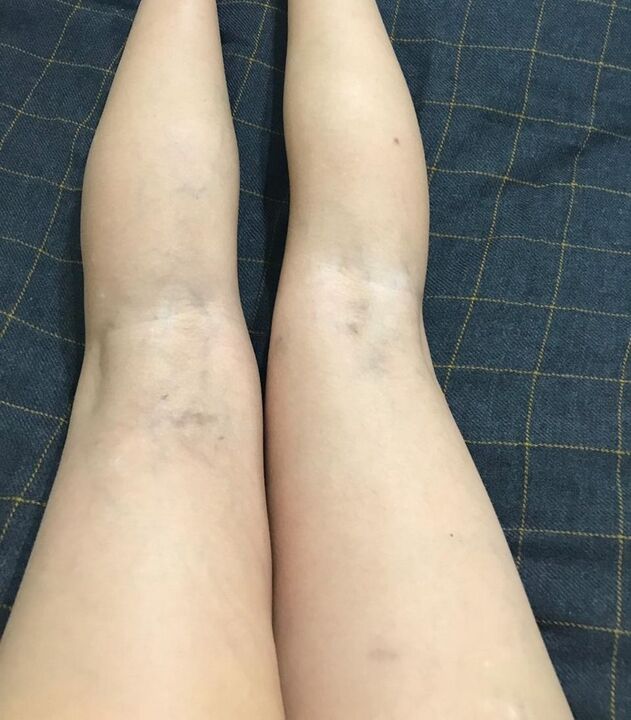 Manifestacións de varices nas pernas