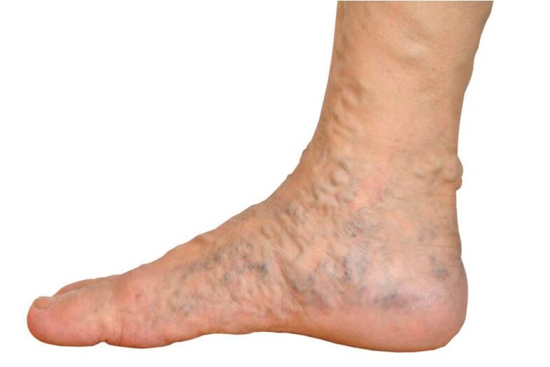 Varices na perna
