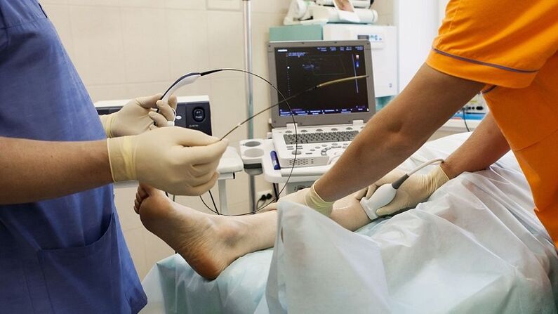 Cirurxía para extirpar varices
