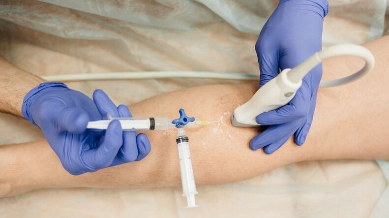 Escleroterapia para varices