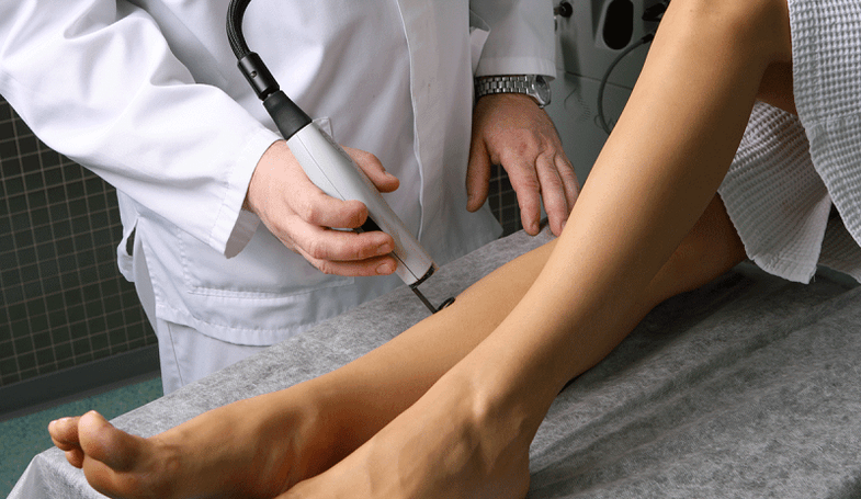 Tratamento con láser de varices