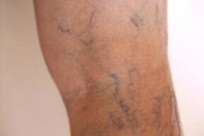 Varices nas pernas