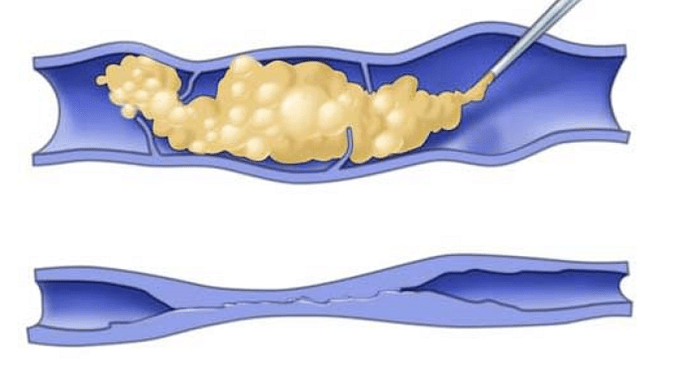 Escleroterapia para varices